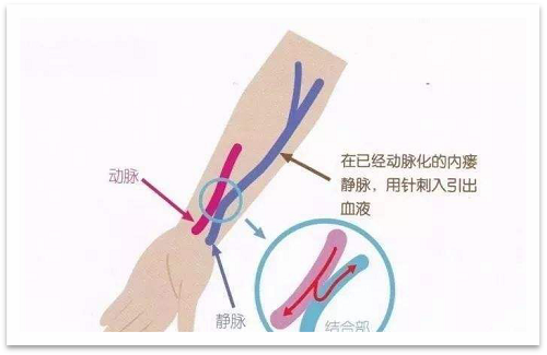 靜脈瘺最新資訊，掌握最前沿的健康信息